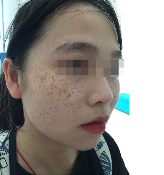 trị nám, tàn nhang