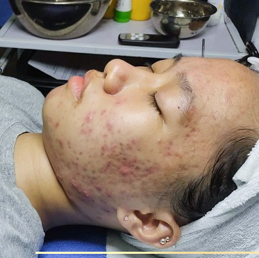 Điều trị mụn